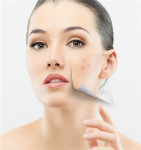Did You Know This Contributes To Adult Acne? By Beauty Salon Scarborough  - Call Us On 0404 072 462